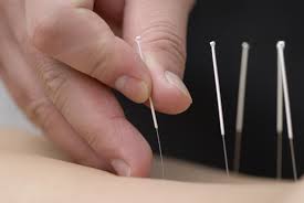 TRADITIONAL NEEDLE ACUPUNCTURE